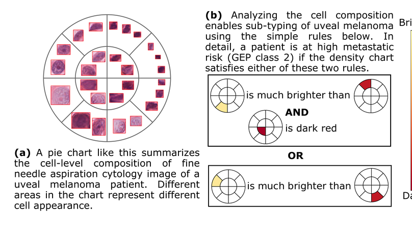 An Interpretable Algorithm for Uveal Melanoma Subtyping from Whole Slide Cytology Images